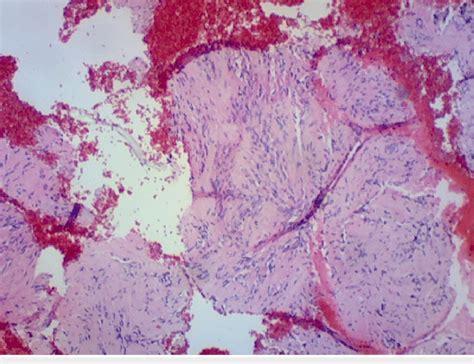 Hande Stain Demonstrating Spindle Cells With Bland Nuclei And Ill Defined