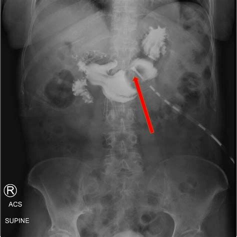 Upright Abdominal X Ray Showing Correct Repositioning Of Peg Tube