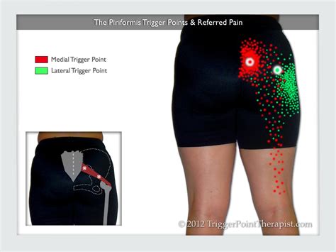 Piriformis Trigger Points Double Trouble