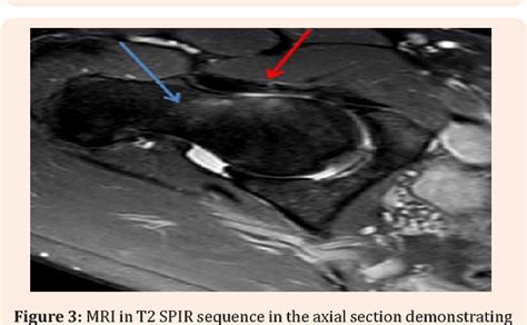 Iliofemoral Ligament Mri