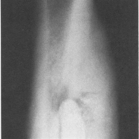 Initial Biopsy Specimen Histologicalfeatures Of Osteoblastoma Showing