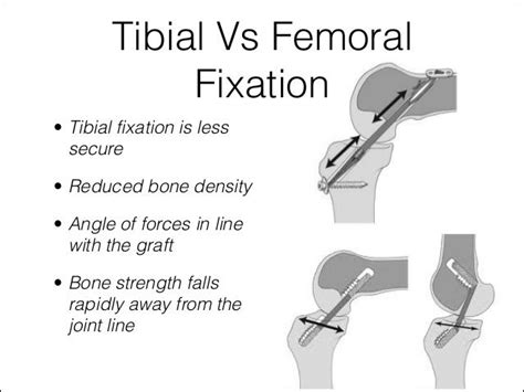 Acl Graft Fixation Options