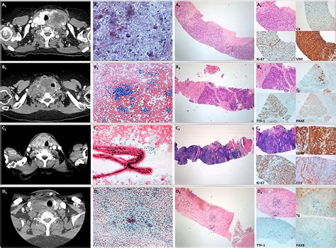 Frontiers Core Needle Biopsy Can Early And Precisely Identify Large