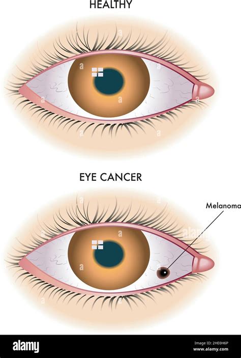 Lillustration Médicale Montre Un œil Sain Par Rapport à Un œil Affecté Par Le Mélanome Image