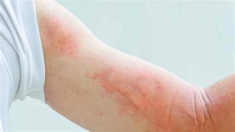 Urticaria Tipos Causas Y Prevención Mejor Con Salud