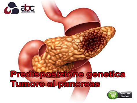 Tumore Pancreas ABC Laboratorio Analisi Cliniche