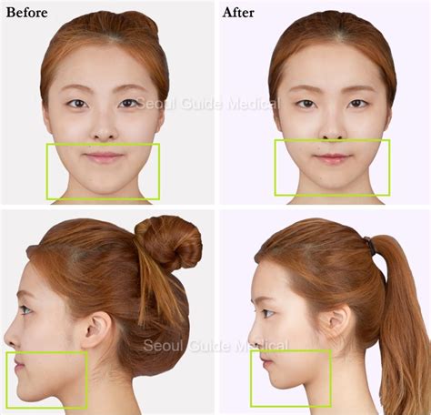 Before And After Double Jaw Surgery Seoul Guide Medical