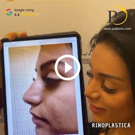 Rinoplastica Video Pallaoro Medical Laser