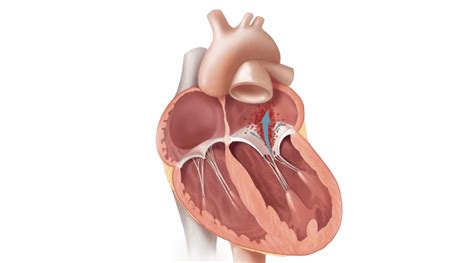 Resilia Mitral Valve Edwards Lifesciences