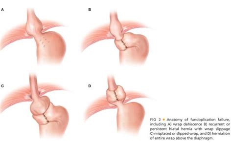 Hiatal Hernia Repair Laparoscopic