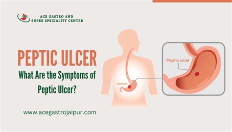 5 Common Symptoms Of Peptic Ulcer Ace Gastro Clinic