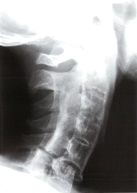 Cervical Ankylosing Spondylitis X Ray