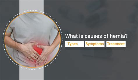 What Is Causes Of Hernia Types Symptoms Treatment Nbkomputer