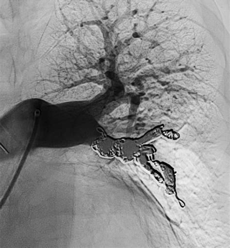 Nonfibered Packing Coil Embolization Of Pulmonary Artery Pseudoaneurysm