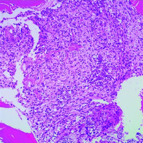 Histopathological Examination Of The Tumor Showed Spindle Cells With An