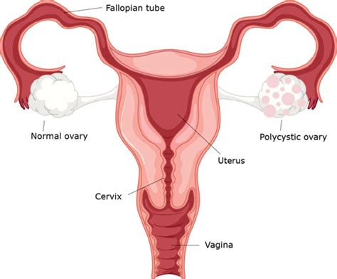 Polycystic Ovarian Syndrome PCOS Healthdirect