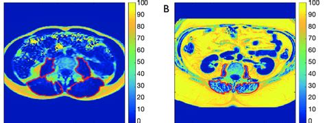 Proton Density Fat Fraction Pdff Maps Representative Axial Pdff Maps