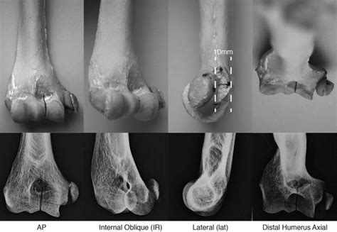 Distal Humerus Fractures Medial Epicondylar Fracture Porn Sex Picture