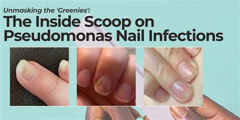 What You Need To Know About Pseudomonas Nail Infections Aka Greenies