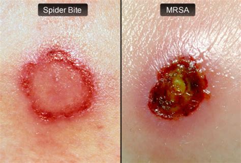 What Is Mrsa And Impetigo Signs And Symptoms Treatment Diagnosis And