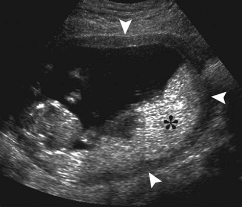 Placenta Accreta Vs Normal Placenta