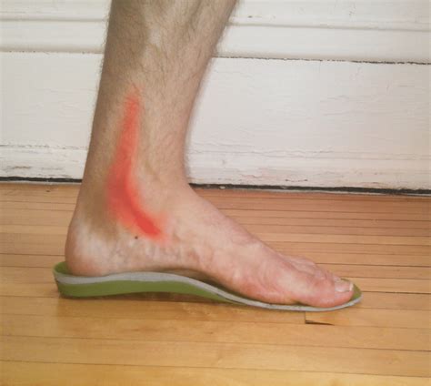 4 Ways to Prevent and Treat Posterior Tibial Tendonitis - Runners Connect