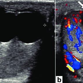 Scrotal pearl. Longitudinal gray-scale ultrasound image of the right ...