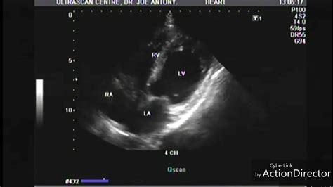 Myocardial Infarction Echocardiography Youtube