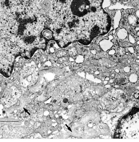 Electron Microscopic Photograph Of Sellar Schwannoma Shows Duplicated