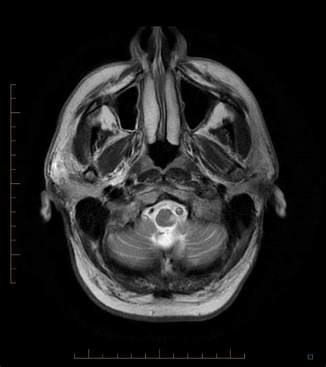 Radiology Cases Lateral Medullary Syndrome Wallenberg