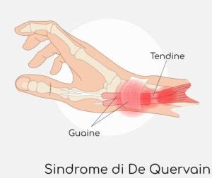 Sindrome Di De Quervain Tenosinovite Del Pollice Sintomi E Rimedi