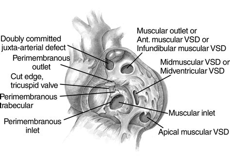 Operative Techniques for Repair of Muscular Ventricular Septal Defects ...