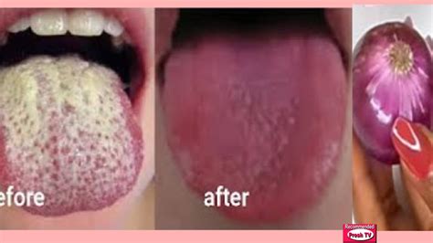 How To Get Rid Of White Tongue And Bad Breath Instantly How To Get A