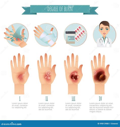 Trattamento Delle Ustioni Grado Di Ustioni Della Pelle Vettore