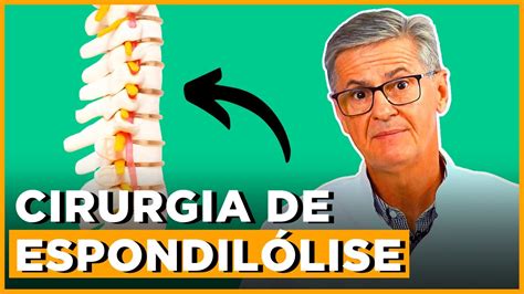 Como é a Cirurgia de Espondilólise Explicação Completa