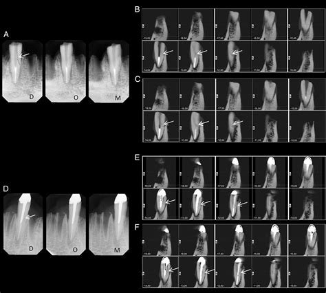 Detection Of Vertical Root Fractures In The Presence Of Intracanal Metallic Post A Comparison