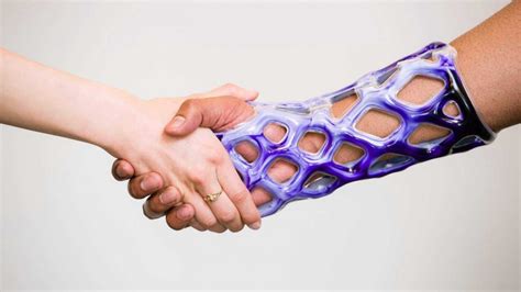 Revolutionary New Orthopaedic Cast Is Lightweight Waterproof And