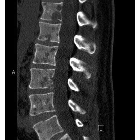 A Metastasis To The Lumbar Spine Histologic Sections Of A Core