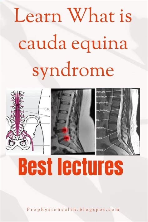 The Study About Cauda Equina Syndrome What Is Cauda Equina Syndrome