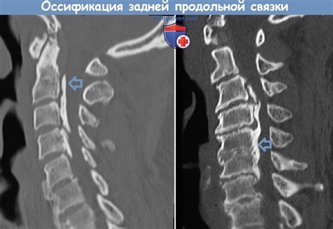 Оссификация задней продольной связки - методы диагностики, лечения по ...