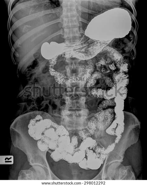 Xray Image Plain Abdomen Colon Stock Photo Edit Now