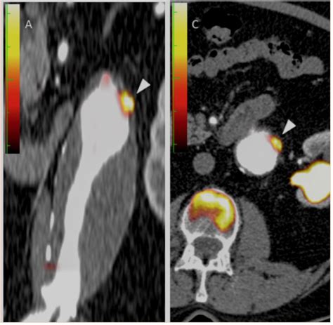 Greater Aortic Inflammation And Calcification In Abdominal Aortic