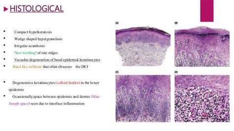 Lichen Planus And Lichenoid Disorders