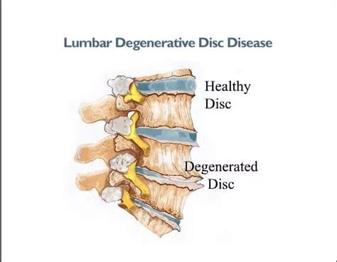 Learn Everything About Lumbar Disc Degeneration Pathology - El Paso, TX ...