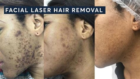 Can Laser Hair Removal Get Rid Of Ingrown Hairs Online