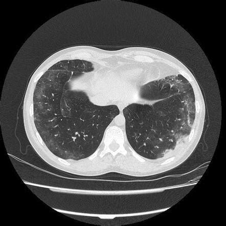 Eosinophilic Granulomatosis With Polyangitis Radiology Case