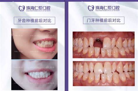 珠海牙科种植医院排名公布看珠海种植牙哪家医院比较好种植牙 8682整形网