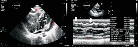 Transthoracic Echocardiography In Apical 4 Chamber View A In Diastole