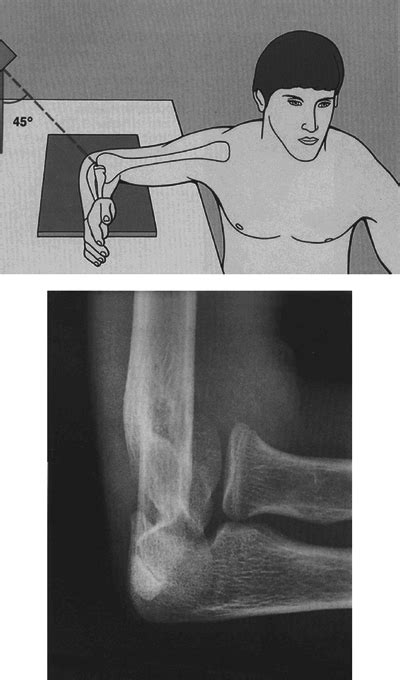 Radial Head Teachme Orthopedics