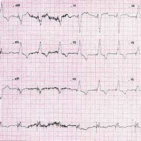 Standard Left Sided Lead Ekg Demonstrating Normal Sinus Rhythm With